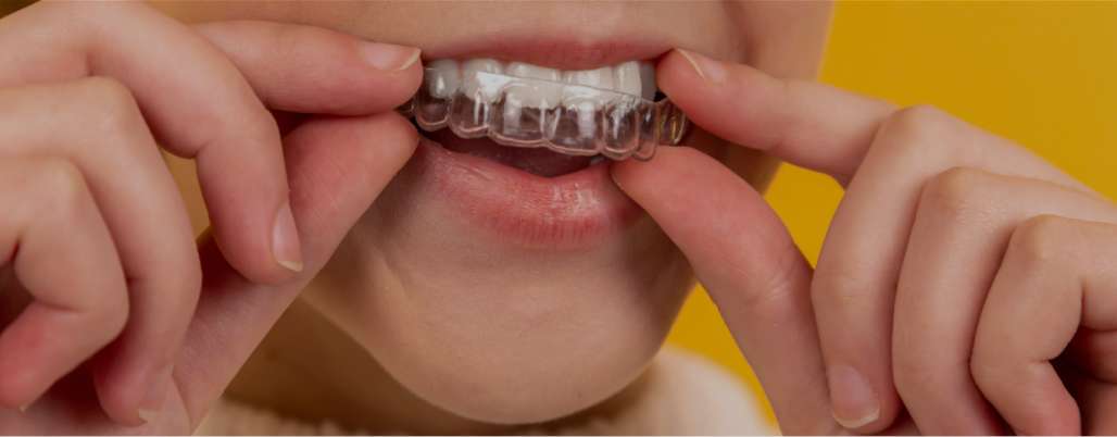 Person wearing Invisalign invisible braces